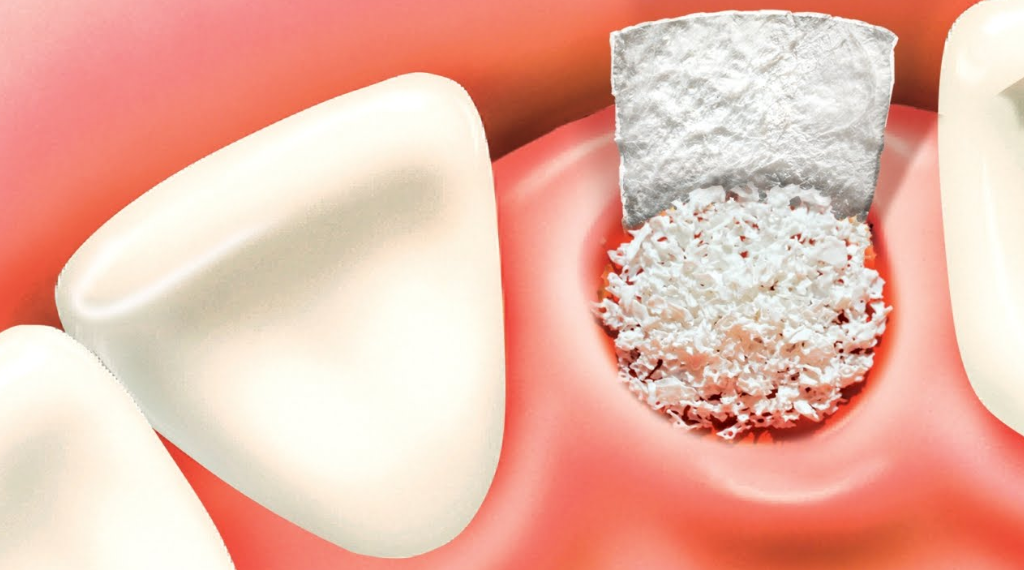 bone-graft-dental-implant