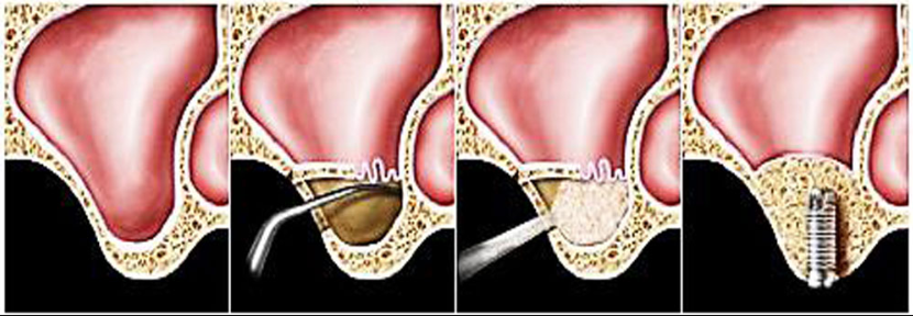 lateral-wall-sinus-graft-dental-implants